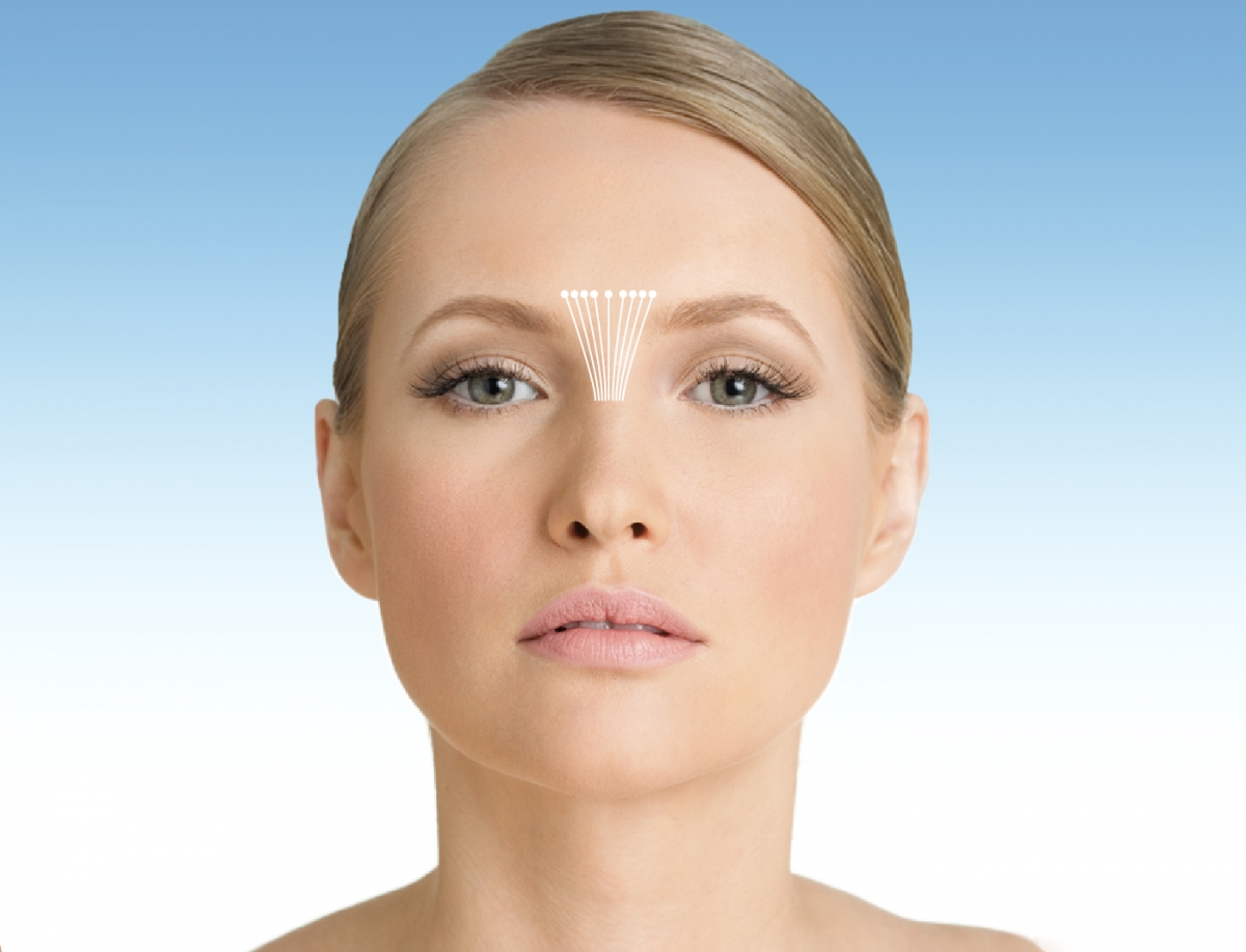 Interebrow, wrinkles on the forehead