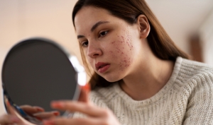 Treatment for acne skin with mild inflammation