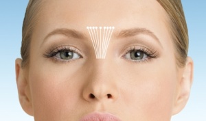 Interebrow, wrinkles on the forehead