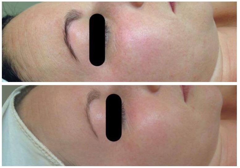 Before and after therapy of Anti-Ageing & Redness 