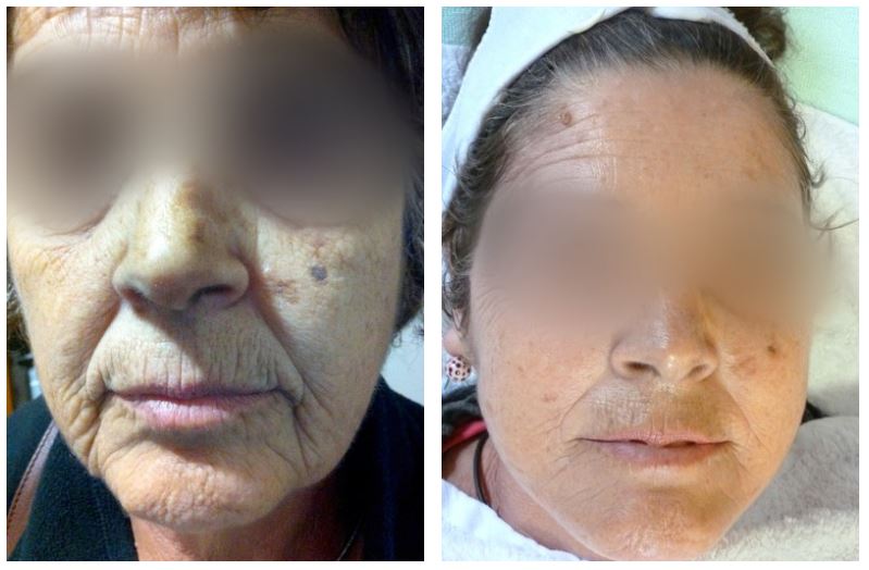 Before and after therapy of Clinical Anti-Ageing