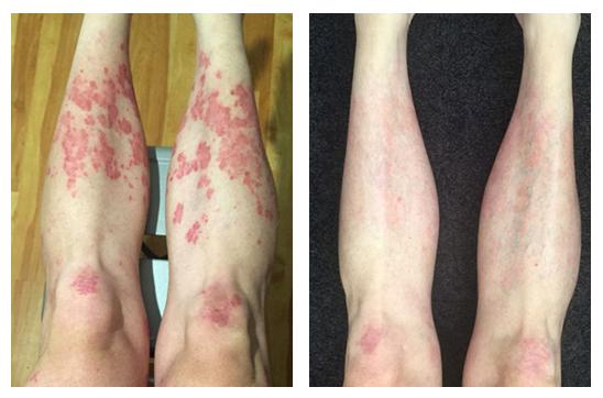 Before and after therapy of Psoriasis