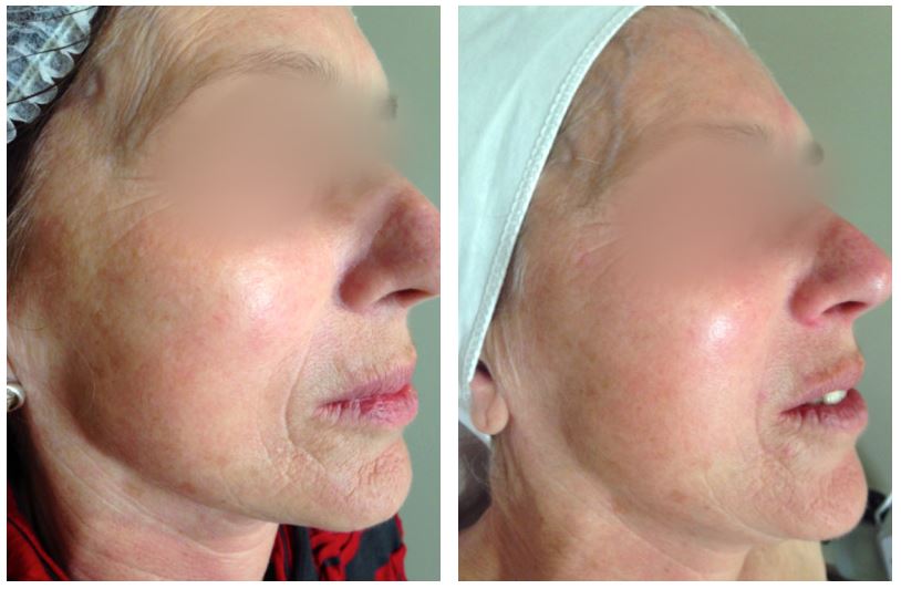 Before and after therapy of Anti-Ageing  
