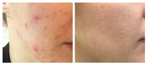 Before and after therapy of Mild Acne