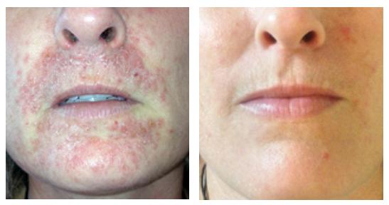 Pirms un pēc ādas iekaisuma procesa ārstēšanas