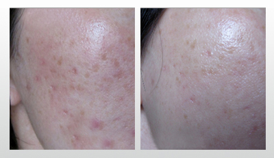 До и после терапии рубцов post-acne