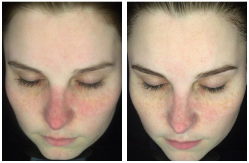Before and after therapy of Anti-Redness & Congestion